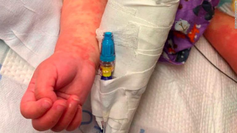 Rara enfermedad de niños asociada al nuevo coronavirus