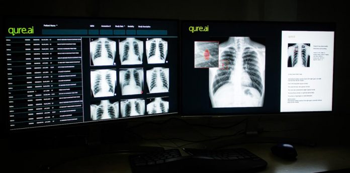 IA aplicada en radiografía de tórax reduce errores en un 50%